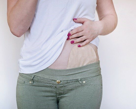 Frau mit Stoma